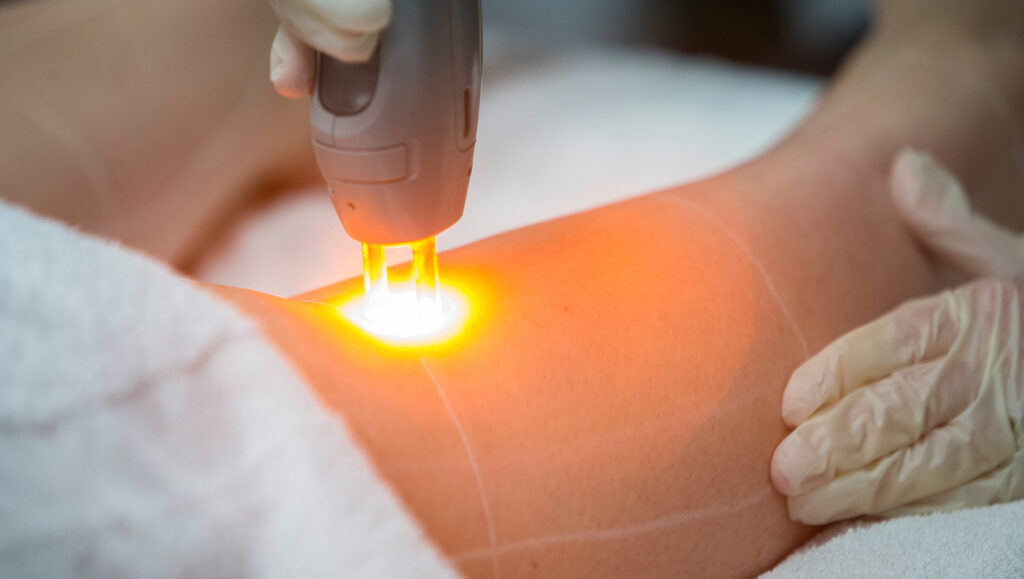 Laser treatments starting at $25