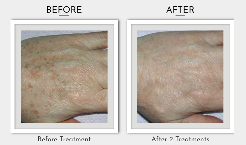 Hyperpigmentation: How Spa Treatments Can Help Fade Dark Spots - La ...